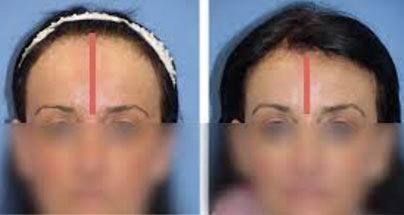 Forehead reduction in young female patient | Ocean Clinic Marbella Madrid