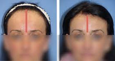 Forehead reduction in young female patient | Ocean Clinic Marbella