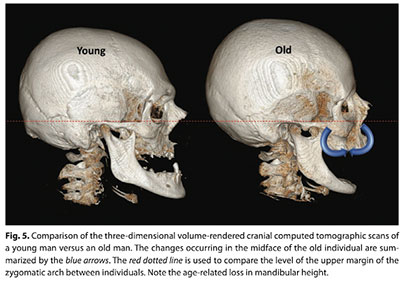 Aging of the Forehead Bone, fig.3 | Marbella Ocean Clinic