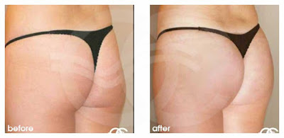 Lipofilling lifting brésilien: subir une liposuccion ramolit la peau