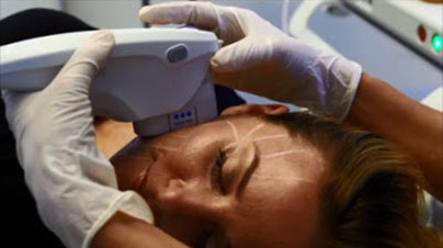 High Intensity Focused Ultrasound - HIFU Marbella Ocean Clinic