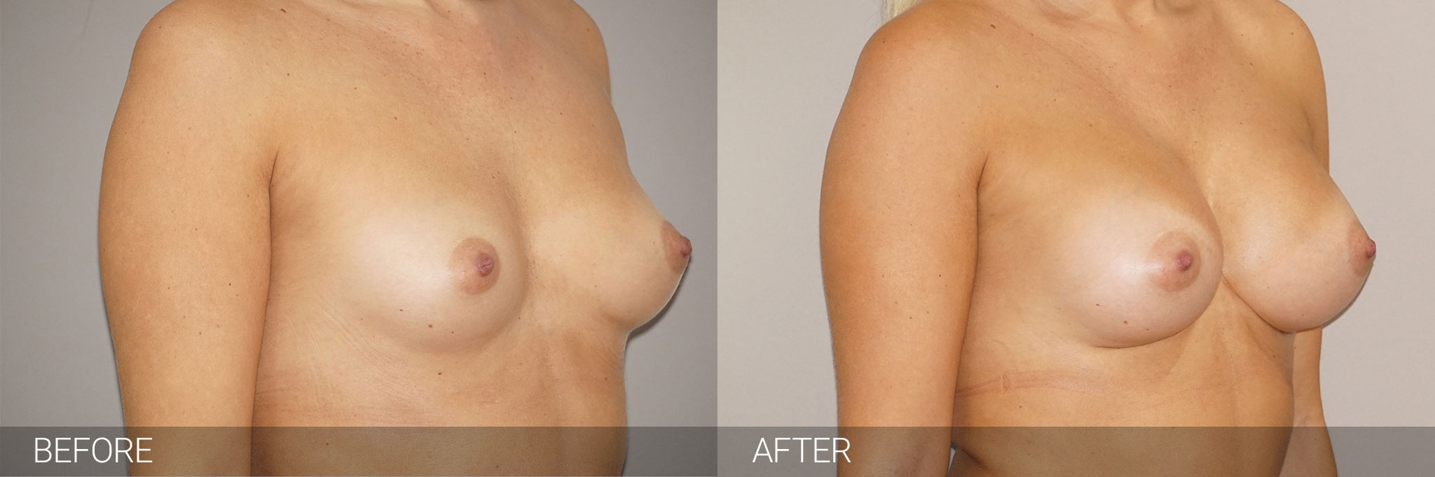 Unhappy in a bikini - Breast implants or breast uplift