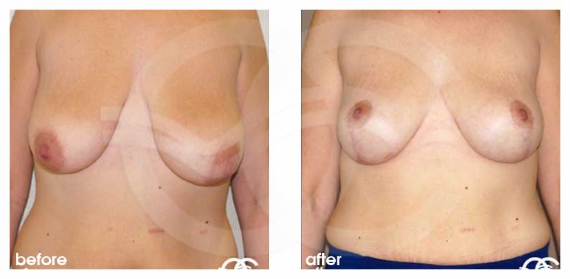 Happy in a bikini - Breast implants or breast uplift