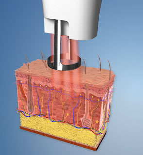 Laser Skin Treatment. Marbella Ocean Clinic