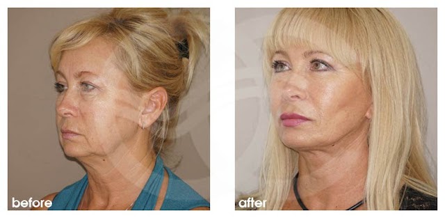 Lip augmentation with fat transfer - Marbella Madrid | Ocean Clinic