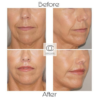 Lip lift surgery - Cheiloplasty - Marbella | Ocean Clinic