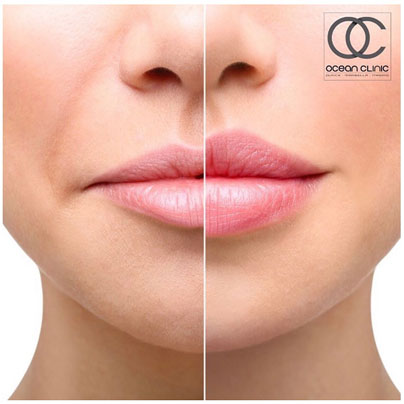 What are the results of a lip flip? | Ocean Clinic Marbella Madrid