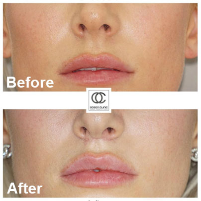 What are the results of a upper lip lift? Before and after | Ocean Clinic Marbella Madrid