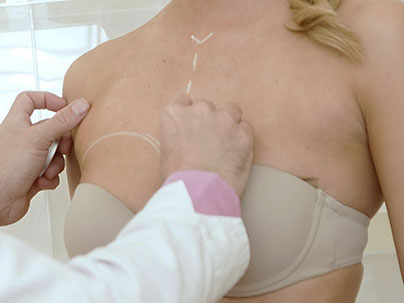 Lipofilling Breast | Ocean Clinic Marbella