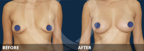 Lipofilling Breast | Ocean Clinic Marbella