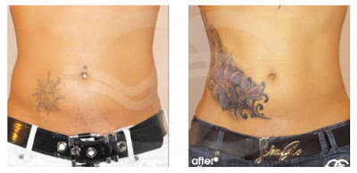 What type of liposuction does Ocean Clinic Marbella offer?