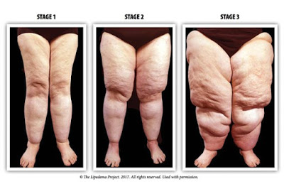 Lipedema  Fat Disorder - Causes, Stages, Symptoms, Diagnosis