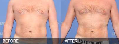 Before and after - Liposuction can reach the parts diet and exercise cannot