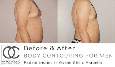 Before and after - Larger areas of fat can be tackled with liposuction