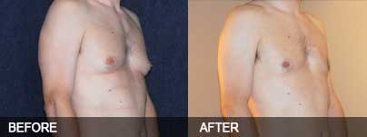 Before and after - Male breasts can be treated with liposuction