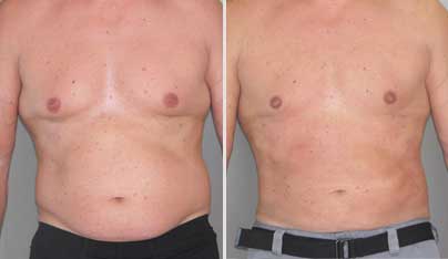 Liposuction for Men - 10 Facts