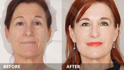 Liquid facelift Process | Ocean Clinic Marbella