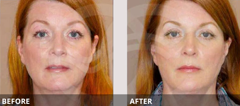 MACS Facelift Techniques | Ocean Clinic Marbella