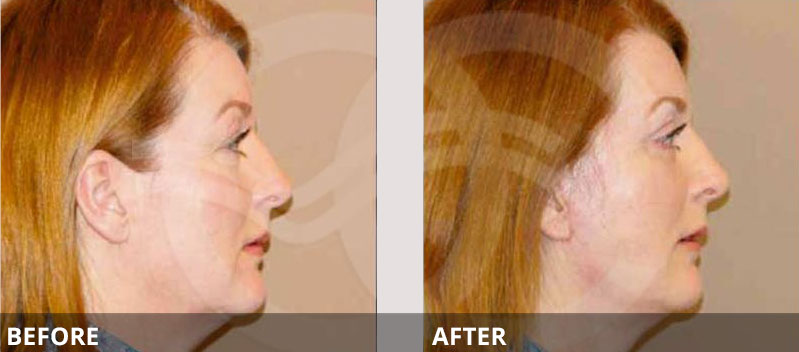 MACS - Fat Transfer for Facial Sculpting | Ocean Clinic Marbella