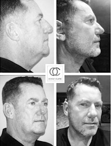 How do male and female facelifts differ? Marbella Ocean Clinic