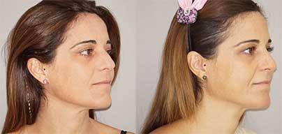 Micro Fat Transfer - Facial Fat Grafting