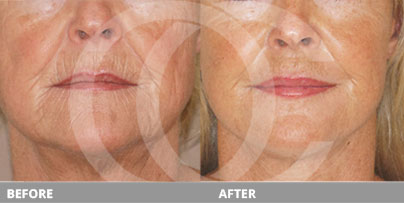 Benefits of Minimally Invasive Neck Lift Before and After | Marbella Ocean Clinic