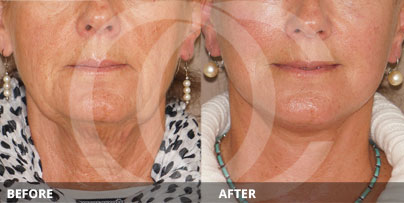 Lipografting Before and After Minimally Invasive Neck Lift | Marbella Ocean Clinic