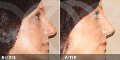 Antes y Después de la Rinoplastia Moderna | Ocean Clinic Marbella