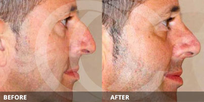 Rinoplastia cerrada (cirugía de nariz) - Antes y Después de la Rinoplastia Moderna | Ocean Clinic Marbella