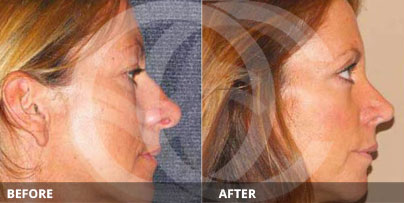Remodelación de la punta nasal y eliminación de la giba - Antes y Después de la Rinoplastia Moderna | Ocean Clinic Marbella