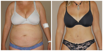 Mommy Makeover before and after Ocean Clinic Marbella