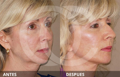 Before & after photos Nanofat grafting | Ocean Clinic Marbella