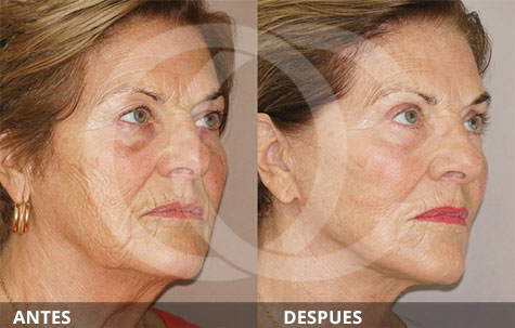 Fat Grafting for Facial Rejuvenation with Nanofat Grafts | Ocean Clinic Marbella