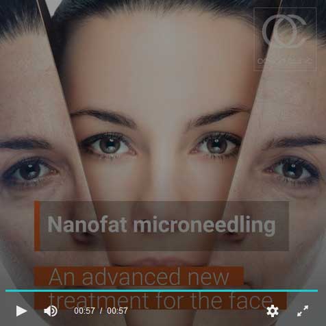 Nanofat Microneedling Facelift