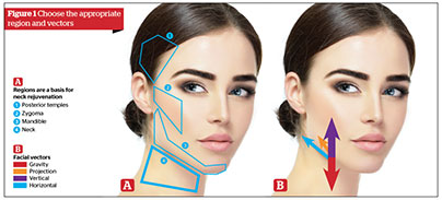 A Systematic Approach to Non-Surgical Neck Rejuvenation, figure-1 | Gabriela Casabona Ocean Clinic