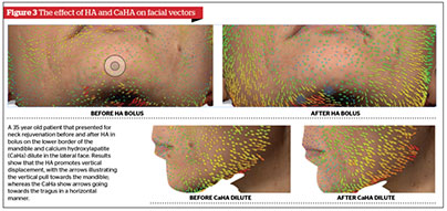 A Systematic Approach to Non-Surgical Neck Rejuvenation, figure-3 | Gabriela Casabona Ocean Clinic