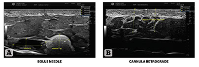 A Systematic Approach to Non-Surgical Neck Rejuvenation, figure-4 | Gabriela Casabona Ocean Clinic