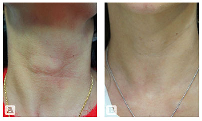 A Systematic Approach to Non-Surgical Neck Rejuvenation, figure-6 | Gabriela Casabona Ocean Clinic