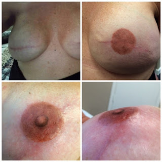 Reconstruction of the nipple areola | Marbella Ocean Clinic