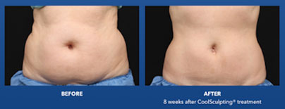 Best for fat loss: Coolsculpting - Non Surgical Body Treatments Marbella