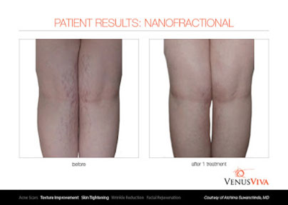 Best for stretch marks: Venus Viva & Dermapen 4 - Non Surgical Body Treatments Marbella