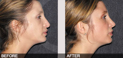 The tip of my nose is ugly | Rhinoplasty Ocean Clinic