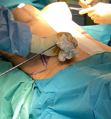 Argon plasma-driven RF skin tightening device: The cannula is moved around in a similar way to a liposuction cannula