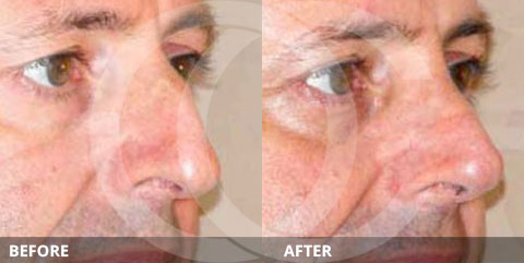 Nose Correction Before & after photos Closed Rhinoplasty (Nose Job). Reshaping of the Nasal Tip, Bridge and Dorsum and Nasal Bone (Hump Removal). Marbella Madrid - Ocean Clinic