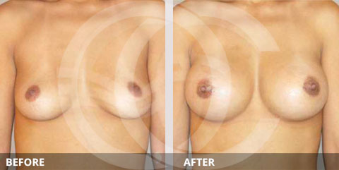 Breast Augmentation Before & after photos with 210cc Anatomic Epipectoral Silicone Breast Implants. Marbella - Ocean Clinic