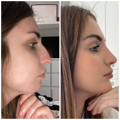 What’s it Like to Have Profiloplasty (Rhinoplasty and a Chin Implant)?