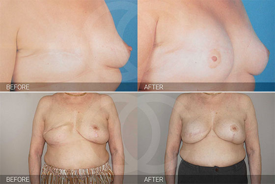 Reconstructive surgery - Breast reconstruction Marbella Ocean Clinic