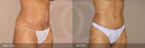 Reconstructive surgery - Scar correction Marbella Ocean Clinic