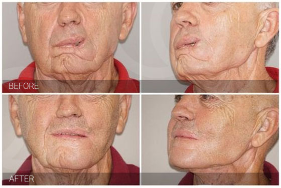 Reconstructive surgery - Facial reconstruction Marbella Ocean Clinic