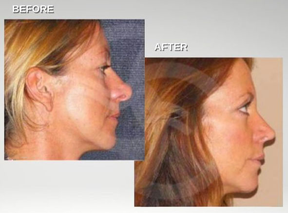 Nasal tip surgery deliver great aesthetic results. Rhinoplasty Ocean Clinic Marbella